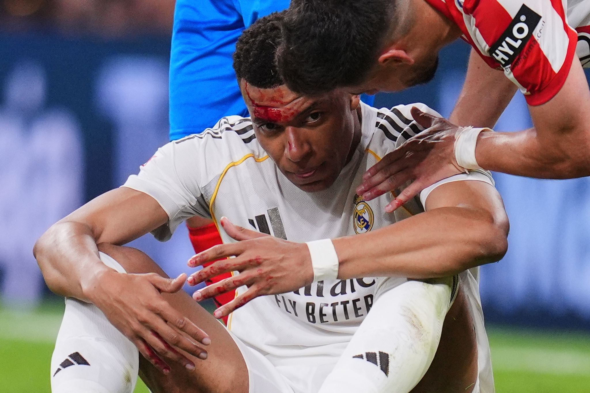 Kylian Mbappé wurde im Spiel gegen Girona im Gesicht getroffen.